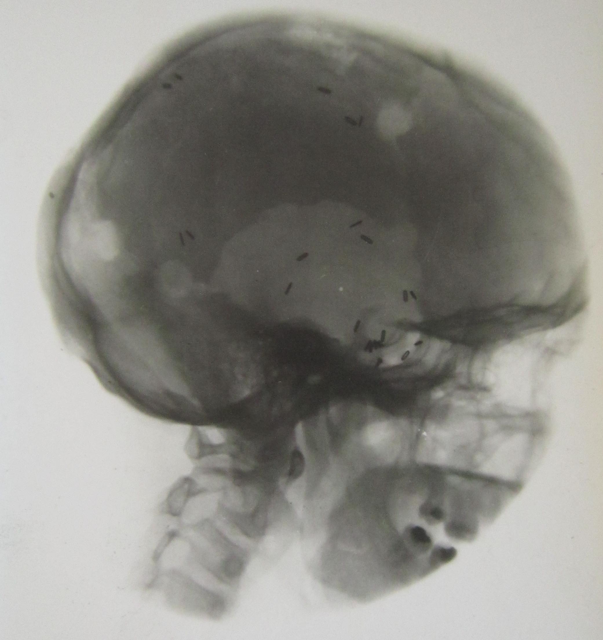 X-ray photograph, 1926